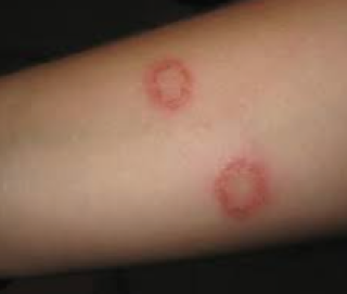 What are the ringworm symptoms?