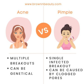 To understand acne and pimples