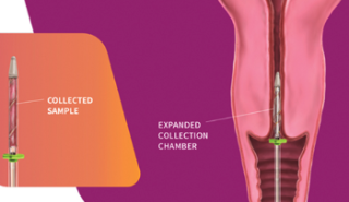 Unveiling the Role of Endocervical Curettage (ECC) in Cervical Cancer Diagnosis