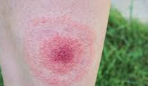 Will my doctor treat me for Lyme disease?