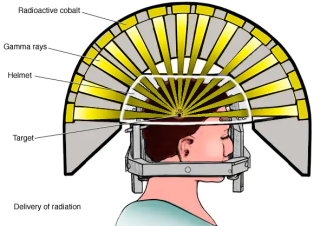 Precision Treatment: Understanding Stereotactic Radiosurgery for Brain Tumors