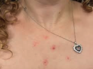 Adornments That Distract: Using Jewelry to Minimize Acne