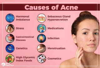 What causes Acnes and Pimples ?