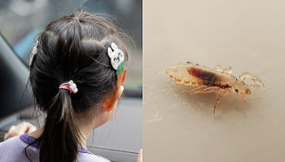 Understanding Head Lice - Tiny Pests Causing Big Itch