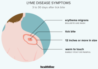 How do I know if I have got Lyme disease?