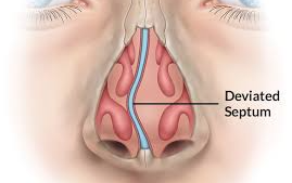 Understanding the Impact of a Deviated Septum on Sinusitis