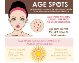 What do age spots look like?