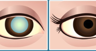 Unveiling the Fog - Understanding the Causes of Cataracts