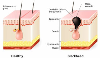 Understanding Blackheads: Causes, Treatment, and Prevention