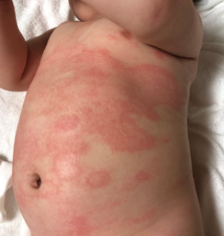 Deciphering Your Baby's Rash: Is it Scabies or Something Else?