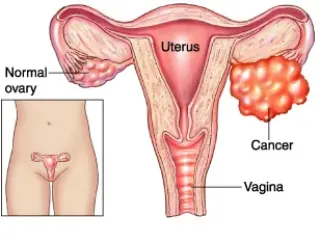 What is ovarian cancer?