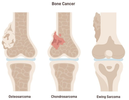 What are the symptoms of bone cancer?