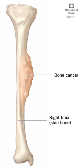 How is bone cancer diagnosed?