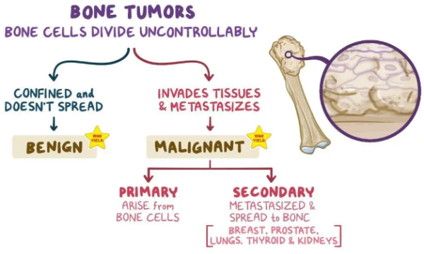 Demystifying Bone Tumors: Understanding Benign and Malignant Varieties