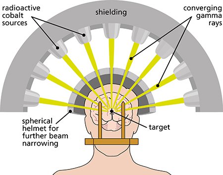 Stereotactic radiosurgery for Brain Cancer