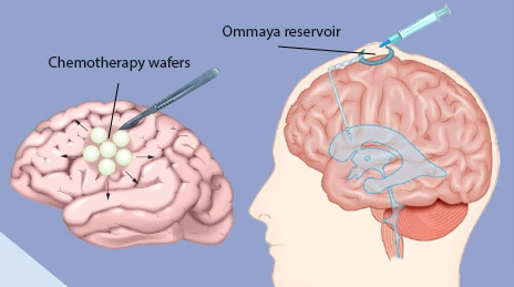 Chemotherapy for Brain Cancer