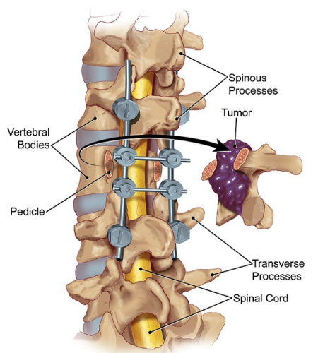 Surgery for Spine Tumors