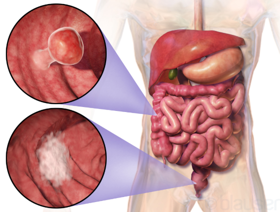 What about a second opinion for Colorectal Cancer?