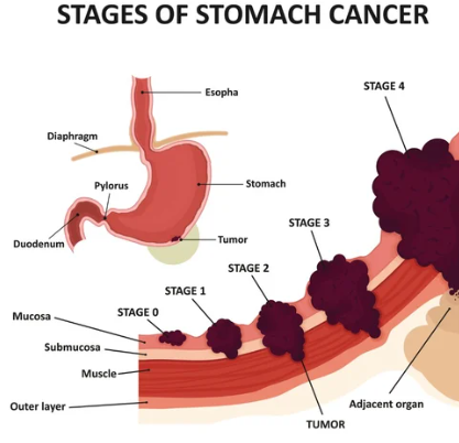 The basic information for Stomach cancer