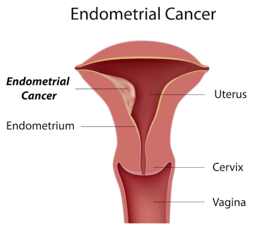 What are the risk factors for endometrial cancer?