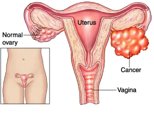 What are the Causes and Risk Factors for Ovarian Cancer?