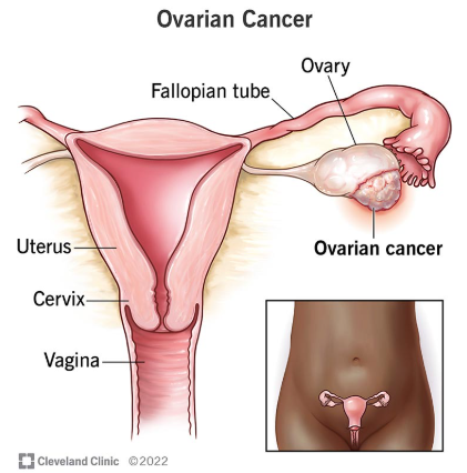 Navigating Ovarian Cancer Treatment - Key Questions to Ask Your Doctor