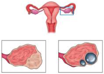 Side effects of Chemotheray for Ovarian Cancer