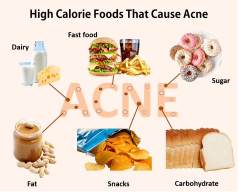 Oily Food, Greasy Food and Acne