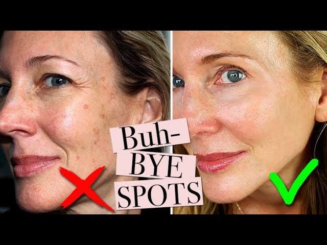 How do I prevent age spots from recurring?