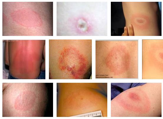 How does Lyme disease infection occur?