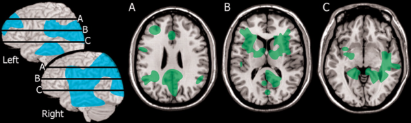 Does Lyme disease affect mental functioning?