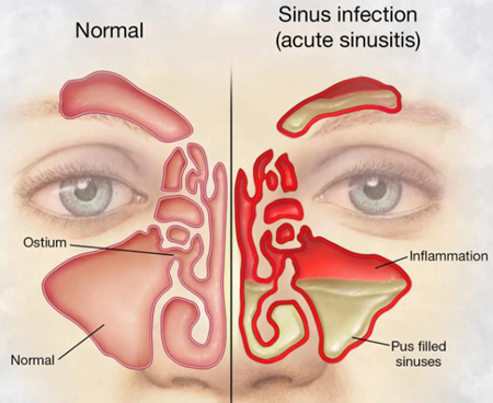 Exploring the Rise in Sinusitis: Understanding the Factors Behind the Increase