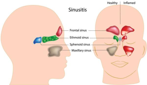 Navigating Side Effects from Sinusitis Medications: What You Need to Know