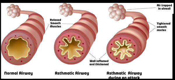 What can I do to prevent my child from developing asthma?