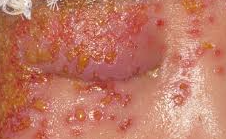 Navigating the Road to Recovery - How is Impetigo Treated?