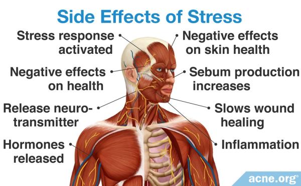 Debunking the Myth: The Relationship Between Stress and Acne