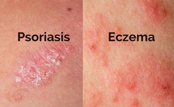 Psoriasis or Eczema - Deciphering Your Baby's Skin Woes