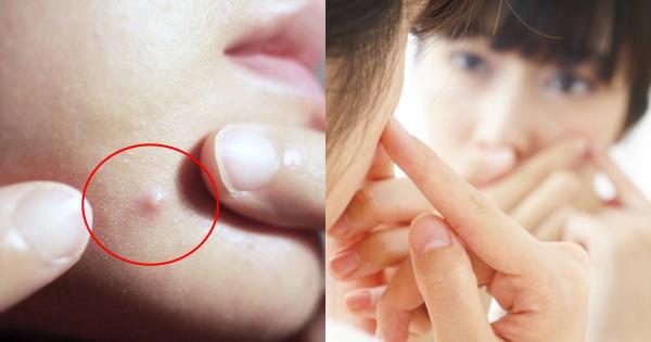 The Harmful Effects of Squeezing Blemishes: Why You Should Avoid It