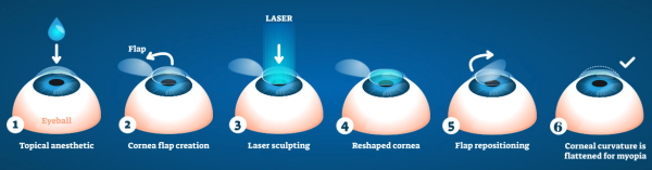 What is LASIK ?