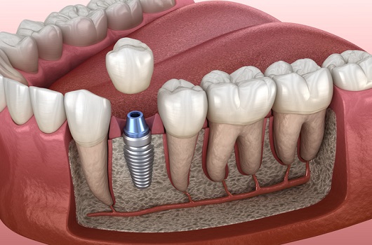 Ensuring the Long-Term Success of Dental Implants: Key Factors