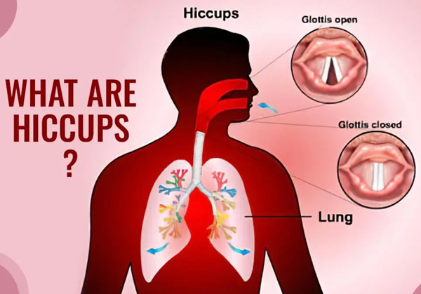 Understanding Hiccups: Unraveling the Mystery Behind the Spasms