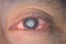 What are the symptoms of a cataract?