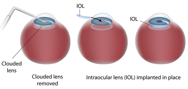 Who is a candidate for cataract surgery?